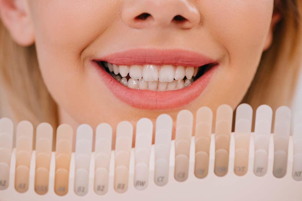 Porcelain Veneers