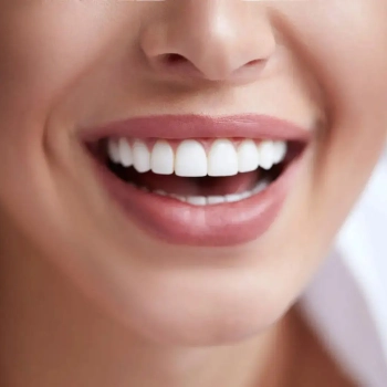 Porcelain Veneers